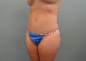 Abdominoplasty Before & After Pictures in Nashville, TN