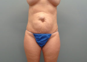 Abdominoplasty Before & After Pictures in Nashville, TN