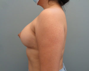 Breast Augmentation Before & After Pictures in Nashville, TN