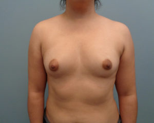 Breast Augmentation Before & After Pictures in Nashville, TN