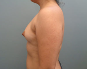 Breast Augmentation Before & After Pictures in Nashville, TN