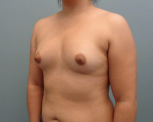 Breast Augmentation Before & After Pictures in Nashville, TN