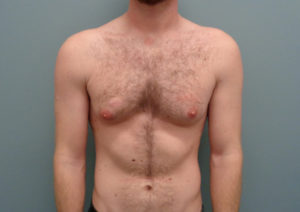 Gynecomastia Before & After Pictures in Nashville, TN