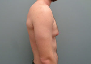 Gynecomastia Before & After Pictures in Nashville, TN