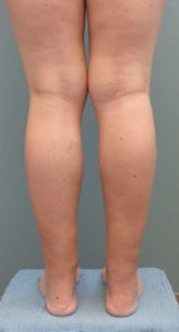 Liposuction Before and After Pictures Nashville, TN