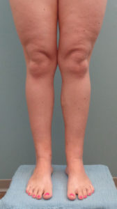 Liposuction Before and After Pictures Nashville, TN