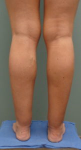 Liposuction Before and After Pictures Nashville, TN