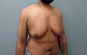 Gynecomastia Before and After Pictures Nashville, TN