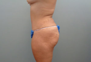 Tummy Tuck Before & After Pictures in Nashville, TN