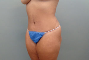 Tummy Tuck Before & After Pictures in Nashville, TN