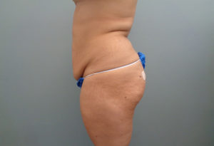 Tummy Tuck Before & After Pictures in Nashville, TN