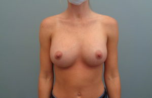 Breast Augmentation Before & After Pictures in Nashville, TN