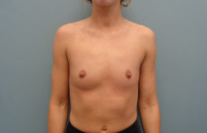 Breast Augmentation Before & After Pictures in Nashville, TN