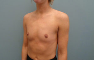 Breast Augmentation Before & After Pictures in Nashville, TN