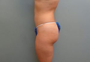 Liposuction Before & After Pictures in Nashville, TN