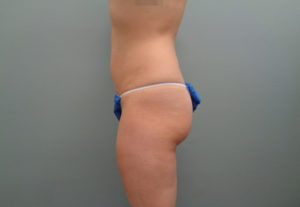 Liposuction Before & After Pictures in Nashville, TN