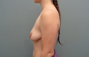 Breast Augmentation with Lift Before & After Pictures in Nashville, TN