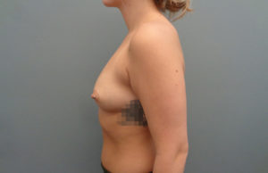 Breast Augmentation Before & After Pictures in Nashville, TN