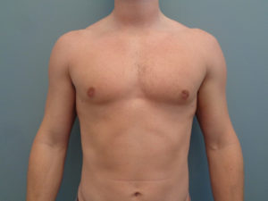 Gynecomastia Before & After Pictures in Nashville, TN