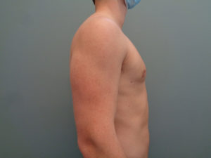 Gynecomastia Before & After Pictures in Nashville, TN
