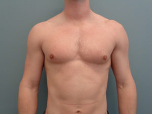 Gynecomastia Before & After Pictures in Nashville, TN