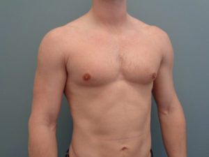 Gynecomastia Before & After Pictures in Nashville, TN