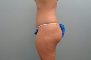 Tummy Tuck Before & After Pictures in Nashville, TN