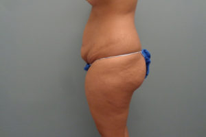 Tummy Tuck Before & After Pictures in Nashville, TN