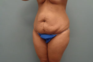 Tummy Tuck Before & After Pictures in Nashville, TN