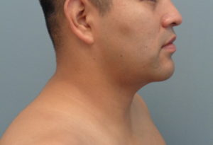 Chin Augmentation Before and After Pictures Nashville, TN