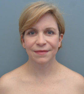 Facelift Before & After Pictures in Nashville, TN