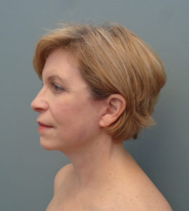 Facelift Before & After Pictures in Nashville, TN