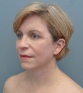 Facelift Before & After Pictures in Nashville, TN