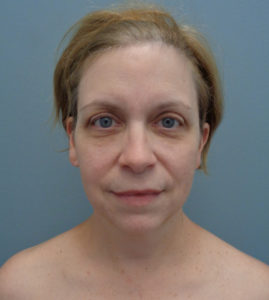 Facelift Before & After Pictures in Nashville, TN