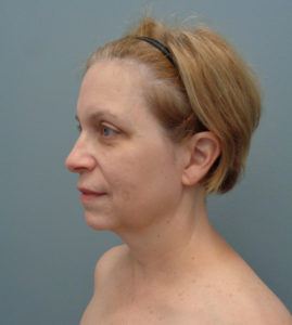 Facelift Before & After Pictures in Nashville, TN