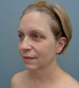 Facelift Before & After Pictures in Nashville, TN