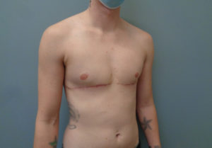 Transgender-Female to Male Before & After Pictures In Nashville, TN