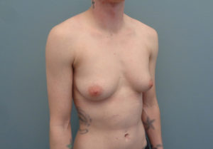 Transgender-Female to Male Before & After Pictures In Nashville, TN