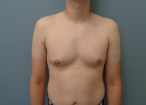 Gynecomastia Before and After Pictures Nashville, TN