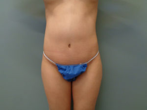 TUMMY TUCK BEFORE & AFTER PICTURES IN NASHVILLE, TN