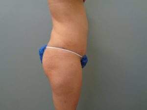 TUMMY TUCK BEFORE & AFTER PICTURES IN NASHVILLE, TN