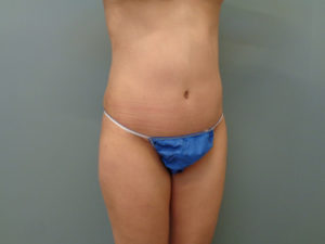 TUMMY TUCK BEFORE & AFTER PICTURES IN NASHVILLE, TN