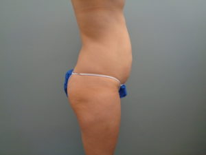 TUMMY TUCK BEFORE & AFTER PICTURES IN NASHVILLE, TN