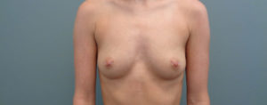BREAST AUGMENTATION BEFORE & AFTER PICTURES IN NASHVILLE, TN