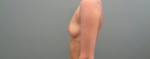 BREAST AUGMENTATION BEFORE & AFTER PICTURES IN NASHVILLE, TN