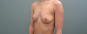 BREAST AUGMENTATION BEFORE & AFTER PICTURES IN NASHVILLE, TN