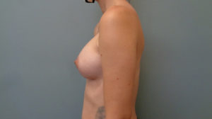 BREAST AUGMENTATION BEFORE & AFTER PICTURES IN NASHVILLE, TN