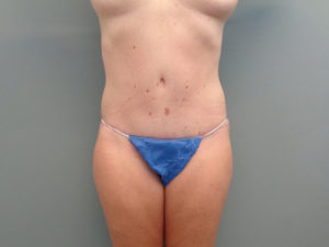 Tummy Tuck Before & After Pictures in Nashville, TN