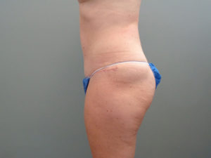 Tummy Tuck Before & After Pictures in Nashville, TN