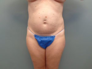 Tummy Tuck Before & After Pictures in Nashville, TN